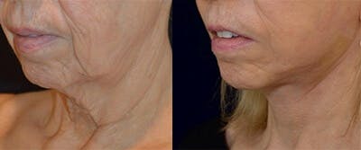 Mini-Facelift Before & After Gallery - Patient 318861 - Image 2
