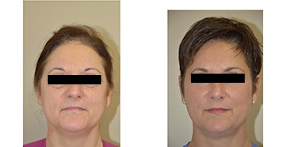 Sculptra Before & After Gallery - Patient 4567103 - Image 1