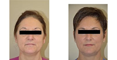 Sculptra Before & After Gallery - Patient 4567103 - Image 1