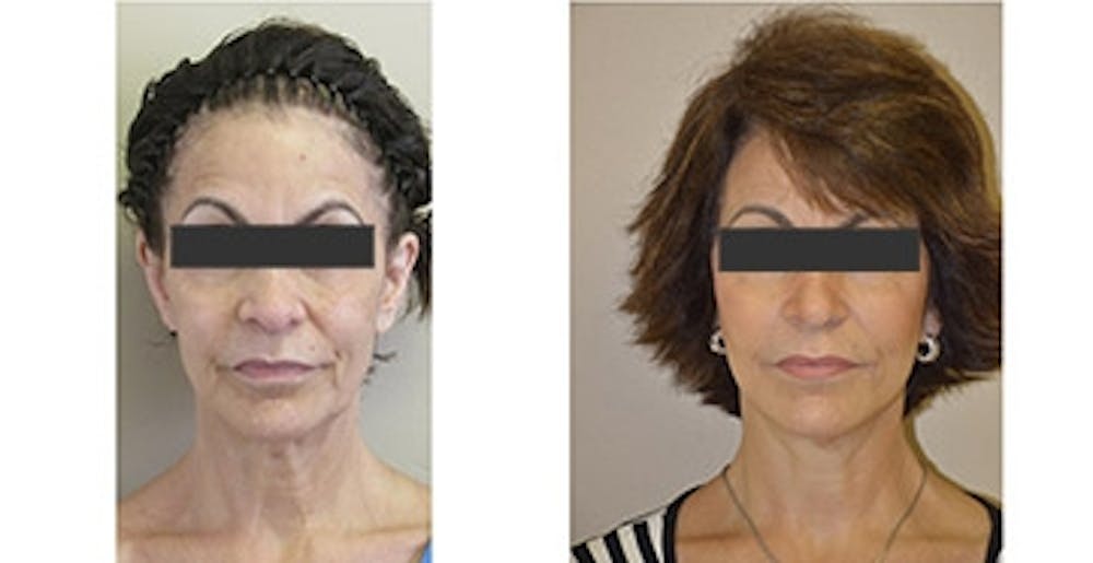 Sculptra Before & After Gallery - Patient 4567104 - Image 1