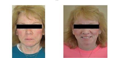 Sculptra Before & After Gallery - Patient 4567105 - Image 1
