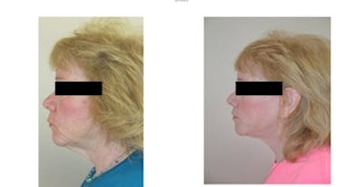 Sculptra Before & After Gallery - Patient 4567106 - Image 1