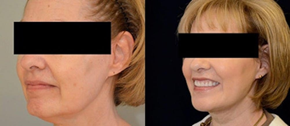 Precision TX Before & After Gallery - Patient 4567110 - Image 1