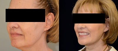 Precision TX Before & After Gallery - Patient 4567110 - Image 1