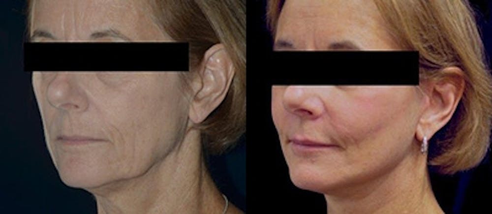 Facial Rejuvenation Before & After Gallery - Patient 4567114 - Image 1
