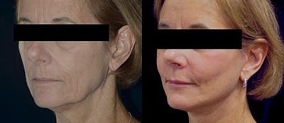 Blepharoplasty Before & After Gallery - Patient 331470 - Image 1