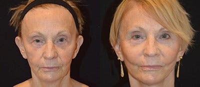 Mini-Facelift Before & After Gallery - Patient 226547 - Image 1