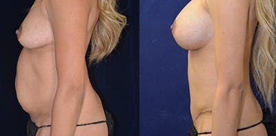 Mommy Makeover Before & After Gallery - Patient 4567123 - Image 1