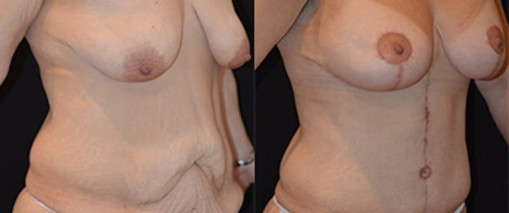 Mommy Makeover Before & After Gallery - Patient 4567125 - Image 1