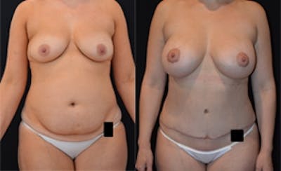 Mommy Makeover Before & After Gallery - Patient 4567126 - Image 1