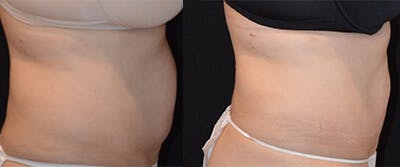 Coolsculpting Before & After Gallery - Patient 4567131 - Image 1