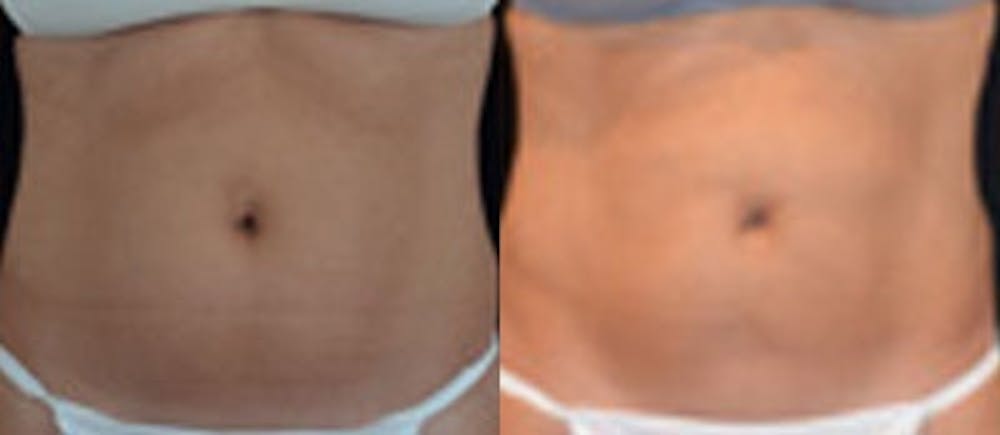 Coolsculpting Gallery - Patient 4567132 - Image 1