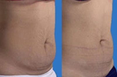 Coolsculpting Before & After Gallery - Patient 4567133 - Image 1