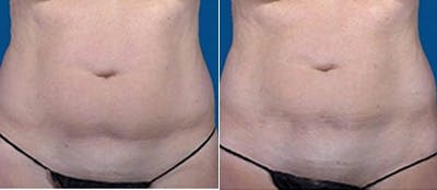 Coolsculpting Before & After Gallery - Patient 4567134 - Image 1