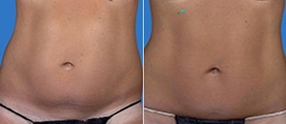 Coolsculpting Before & After Gallery - Patient 4567135 - Image 1