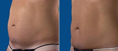Coolsculpting Before & After Gallery - Patient 4567136 - Image 1