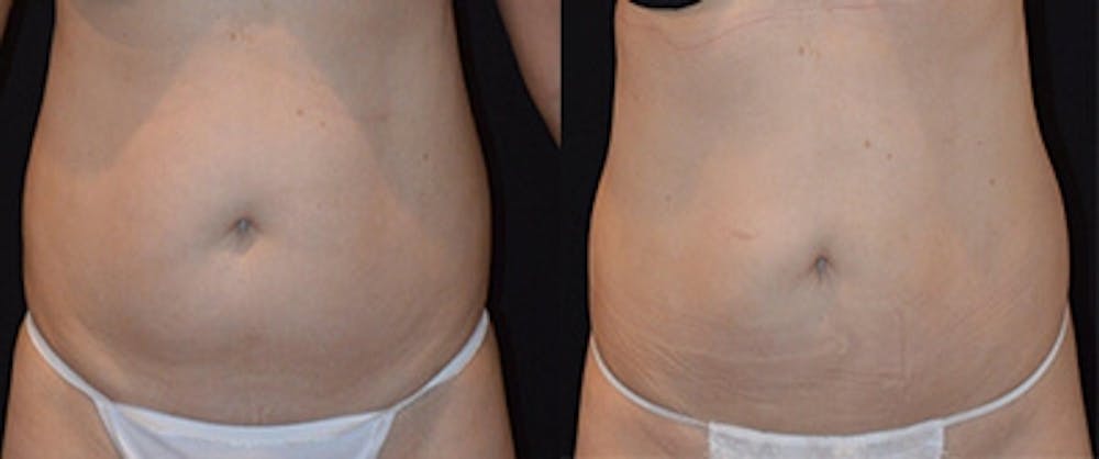 Coolsculpting Gallery - Patient 4567137 - Image 1