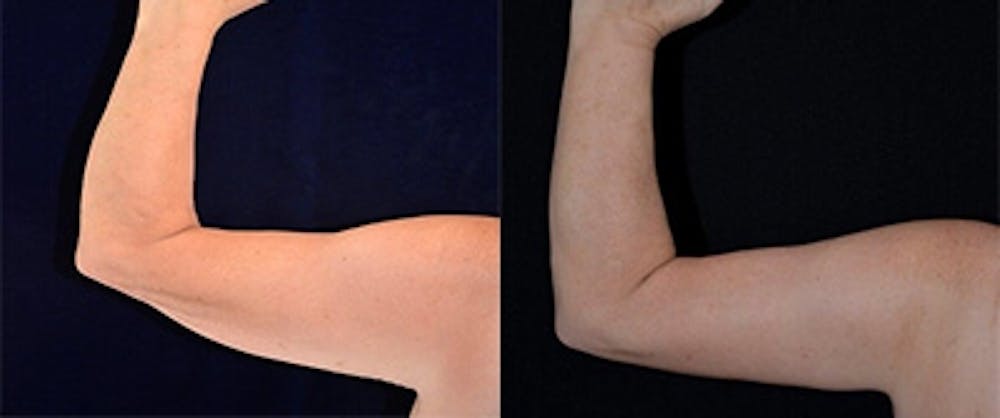 Brachioplasty (Arm Lift) Before & After Gallery - Patient 4567140 - Image 1