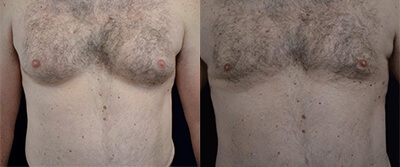 Gynecomastia