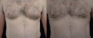Gynecomastia