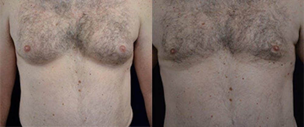 Gynecomastia Reduction Before & After Gallery - Patient 4567176 - Image 1