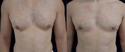Gynecomastia