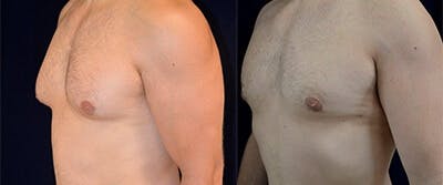 Gynecomastia Reduction Before & After Gallery - Patient 4567180 - Image 1
