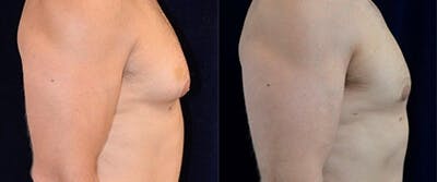 Gynecomastia Reduction Before & After Gallery - Patient 4567181 - Image 1