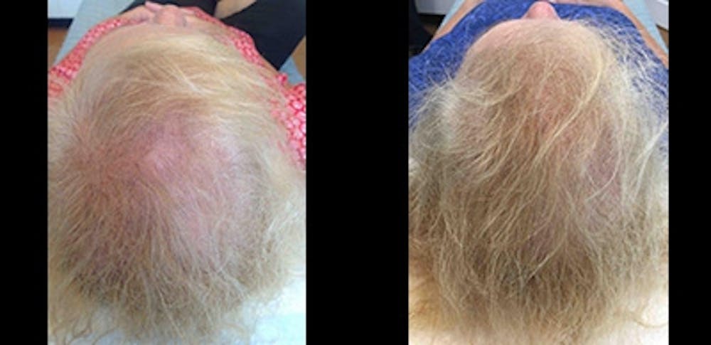 PRP for Hair Restoration Gallery - Patient 4567183 - Image 1