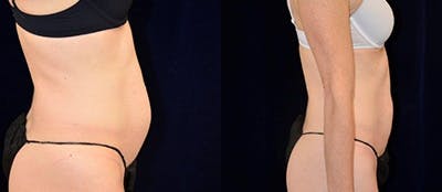 Abdominoplasty Before & After Gallery - Patient 4567198 - Image 1