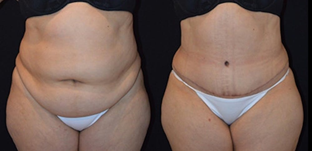 Abdominoplasty Before & After Gallery - Patient 4567202 - Image 1
