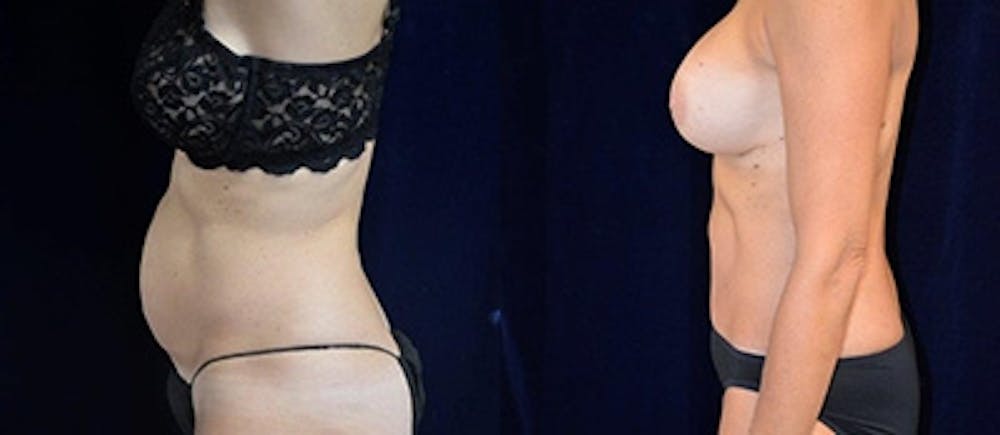 Abdominoplasty Before & After Gallery - Patient 4567203 - Image 1