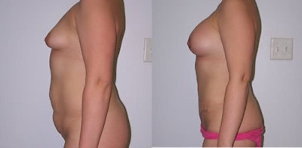 Abdominoplasty Before & After Gallery - Patient 170986 - Image 1