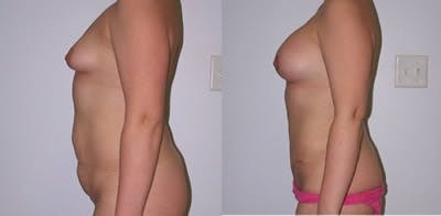 Abdominoplasty Before & After Gallery - Patient 170986 - Image 1