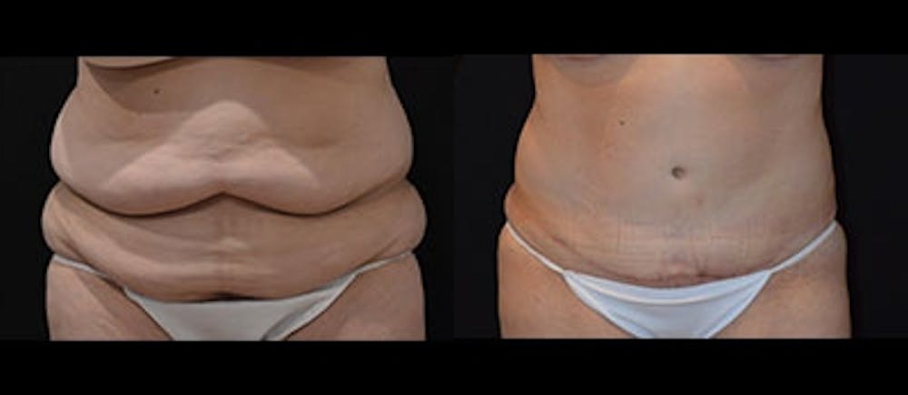 Abdominoplasty Before & After Gallery - Patient 4567206 - Image 1