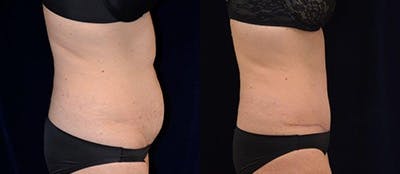 Abdominoplasty Before & After Gallery - Patient 4567207 - Image 1