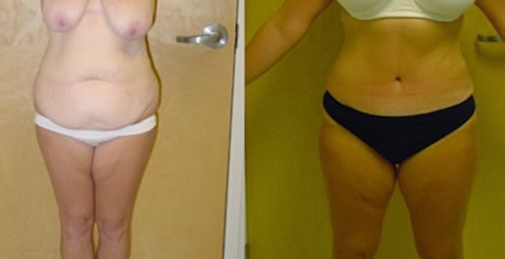 Abdominoplasty Before & After Gallery - Patient 4567208 - Image 1