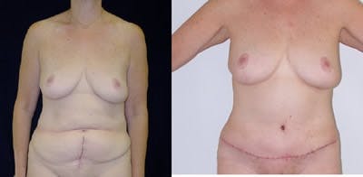Abdominoplasty Before & After Gallery - Patient 248362 - Image 1