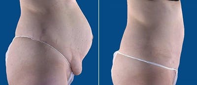 Abdominoplasty Before & After Gallery - Patient 336347 - Image 1