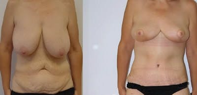 Abdominoplasty Before & After Gallery - Patient 128859 - Image 1