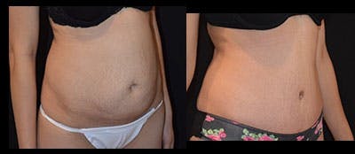 Abdominoplasty Before & After Gallery - Patient 310035 - Image 1