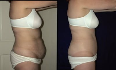 Abdominoplasty Before & After Gallery - Patient 299168 - Image 1