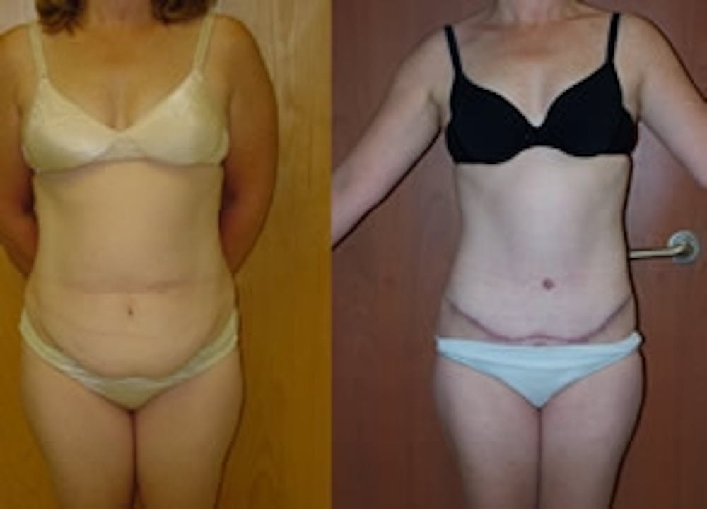 Abdominoplasty Before & After Gallery - Patient 4567220 - Image 1