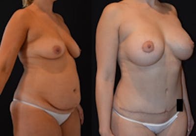 Abdominoplasty Before & After Gallery - Patient 248043 - Image 1