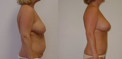 Abdominoplasty Before & After Gallery - Patient 307110 - Image 1