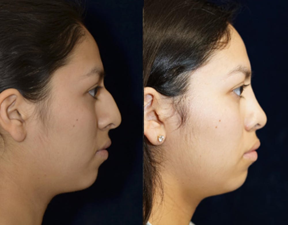 Rhinoplasty Before & After Gallery - Patient 16382515 - Image 1