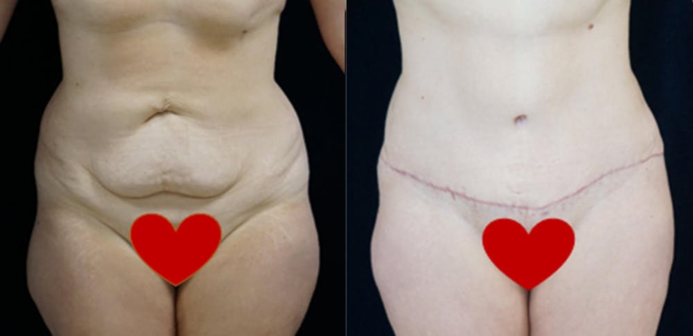 Abdominoplasty Before & After Gallery - Patient 16382564 - Image 1