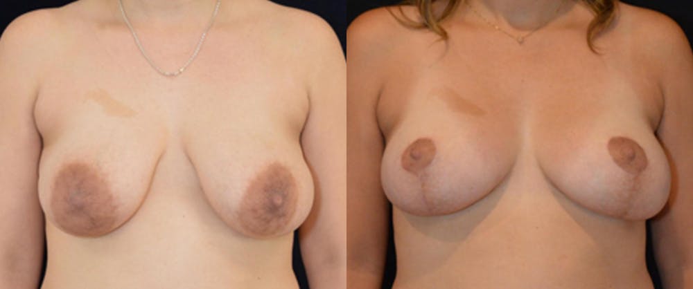 Breast Reduction Before & After Gallery - Patient 16382627 - Image 1