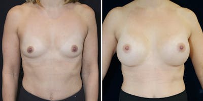 Breast Augmentation Before & After Gallery - Patient 23371222 - Image 1