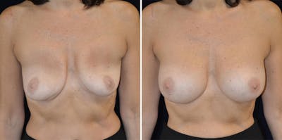 Breast Augmentation Before & After Gallery - Patient 23371333 - Image 1